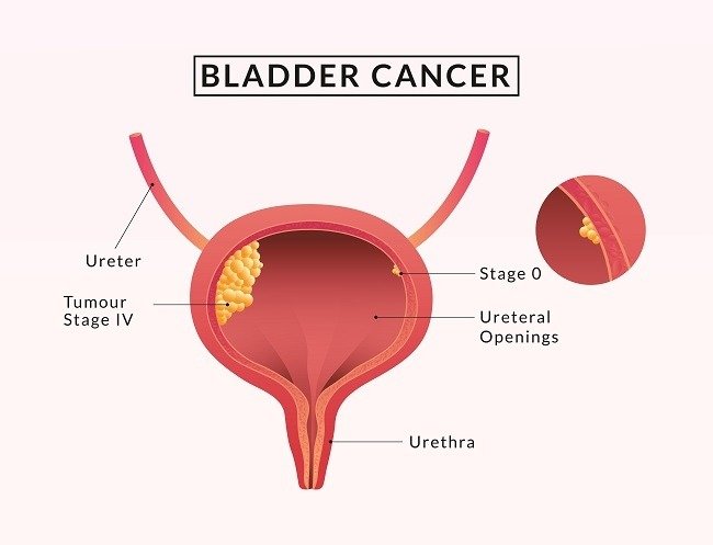 Bladder Cancer Market