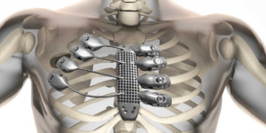 Metal Implants and Medical Alloys Market