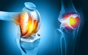 Knee Replacement Market